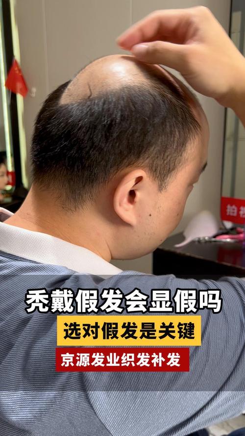 爱心假发：为因病或意外脱发群体带来关怀与自信，你了解多少？