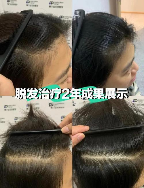 捐献头发意义重大！助脱发群体获新生，还能形成良好风气？