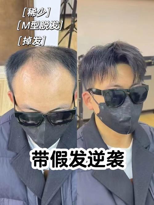 爱心假发：由捐献头发制成，为脱发群体带来精神慰藉